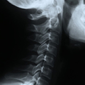 むち打ち症の症状と分類